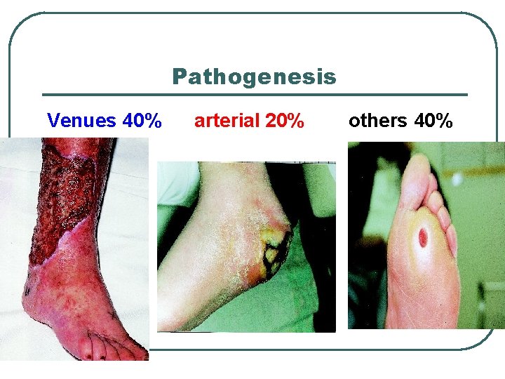 Pathogenesis Venues 40% arterial 20% others 40% 