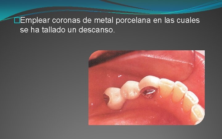 �Emplear coronas de metal porcelana en las cuales se ha tallado un descanso. 