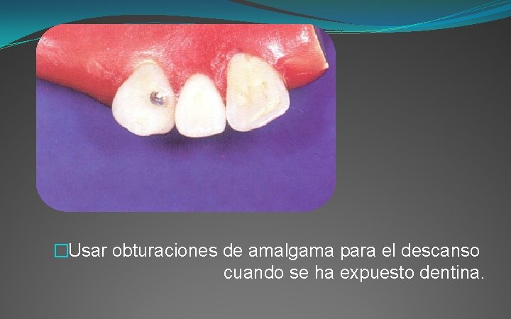 �Usar obturaciones de amalgama para el descanso cuando se ha expuesto dentina. 