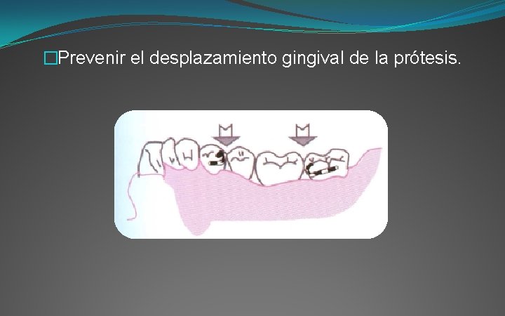 �Prevenir el desplazamiento gingival de la prótesis. 