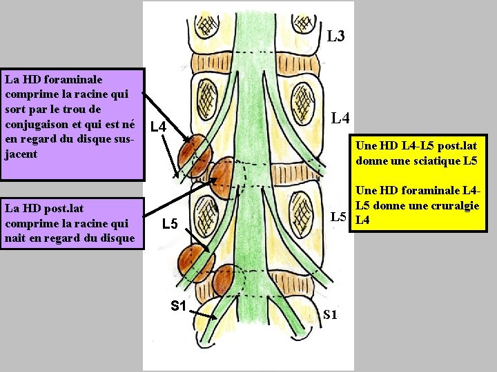 L 3 La HD foraminale comprime la racine qui sort par le trou de