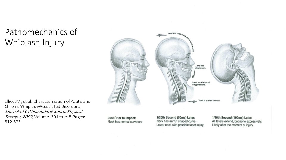 Pathomechanics of Whiplash Injury Elliot JM, et al. Characterization of Acute and Chronic Whiplash-Associated Pathomechanics of Whiplash Injury Elliot JM, et al. Characterization of Acute and Chronic Whiplash-Associated
