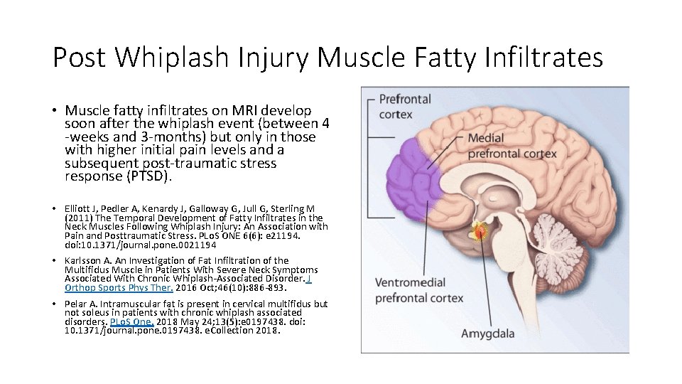 Post Whiplash Injury Muscle Fatty Infiltrates • Muscle fatty infiltrates on MRI develop soon Post Whiplash Injury Muscle Fatty Infiltrates • Muscle fatty infiltrates on MRI develop soon