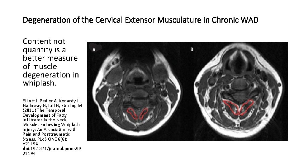 Degeneration of the Cervical Extensor Musculature in Chronic WAD Content not quantity is a Degeneration of the Cervical Extensor Musculature in Chronic WAD Content not quantity is a