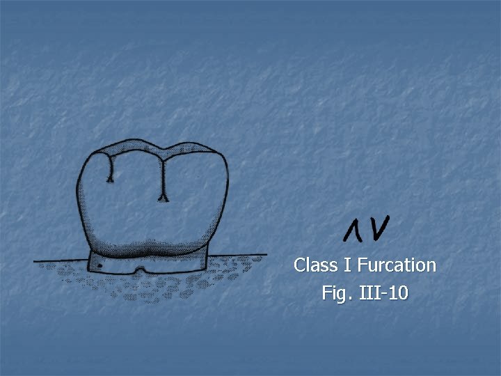 Class I Furcation Fig. III-10 