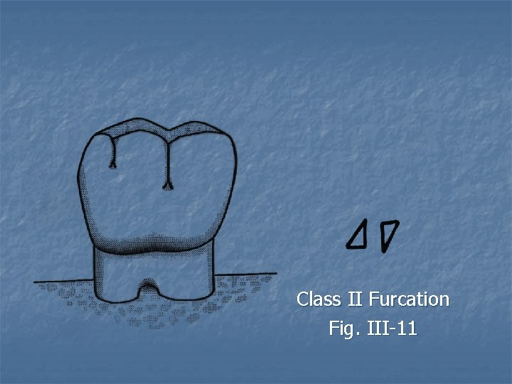 Class II Furcation Fig. III-11 