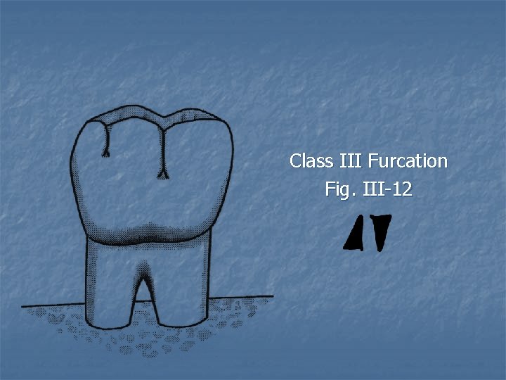 Class III Furcation Fig. III-12 