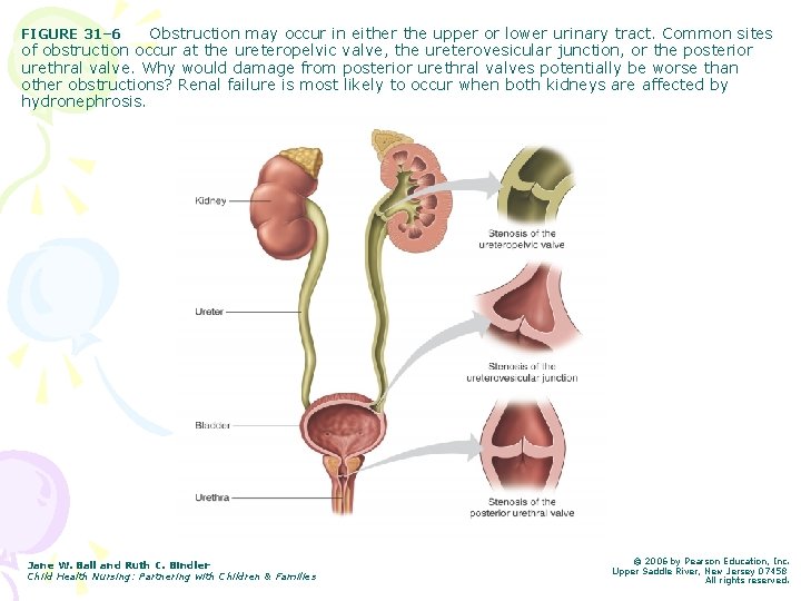 Obstruction may occur in either the upper or lower urinary tract. Common sites of