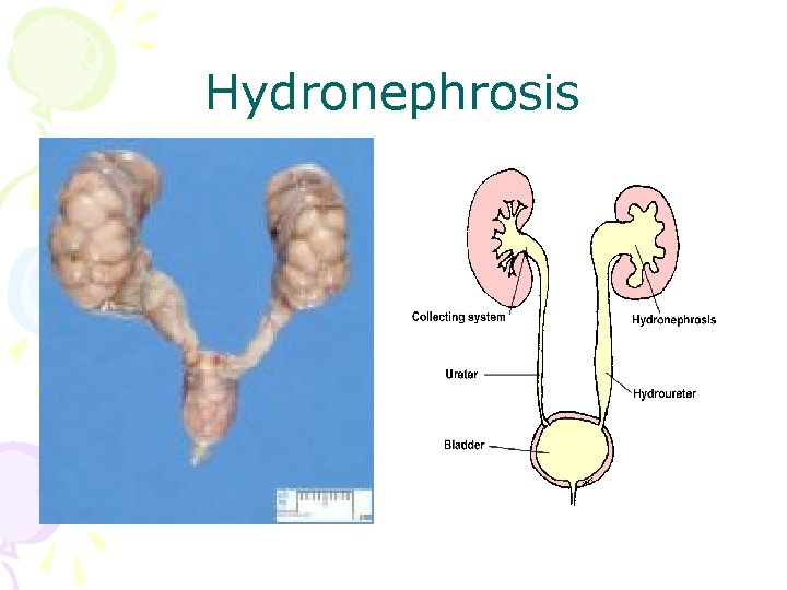 Hydronephrosis 