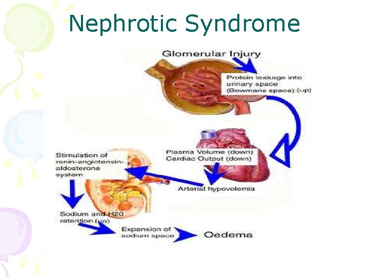 Nephrotic Syndrome 
