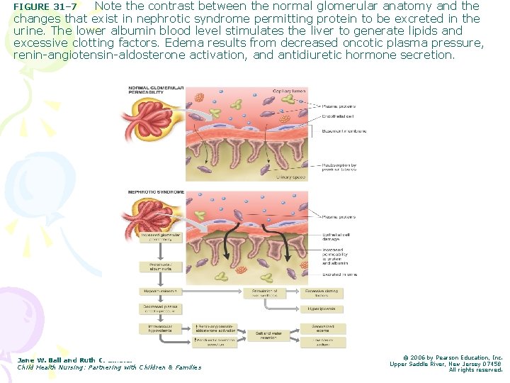 Note the contrast between the normal glomerular anatomy and the changes that exist in