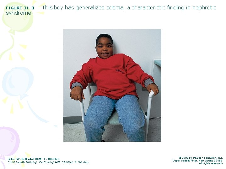 FIGURE 31– 8 syndrome. This boy has generalized edema, a characteristic finding in nephrotic