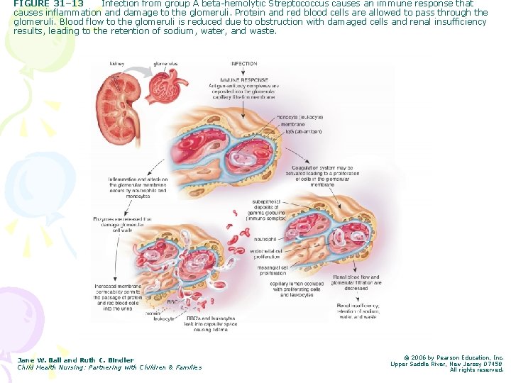 FIGURE 31– 13 Infection from group A beta-hemolytic Streptococcus causes an immune response that