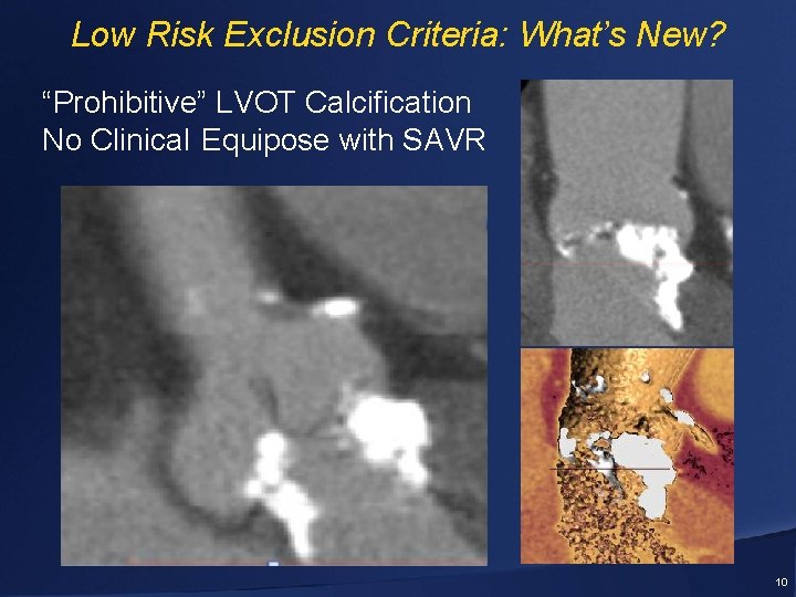 Low Risk Exclusion Criteria: What’s New? “Prohibitive” LVOT Calcification No Clinical Equipose with SAVR