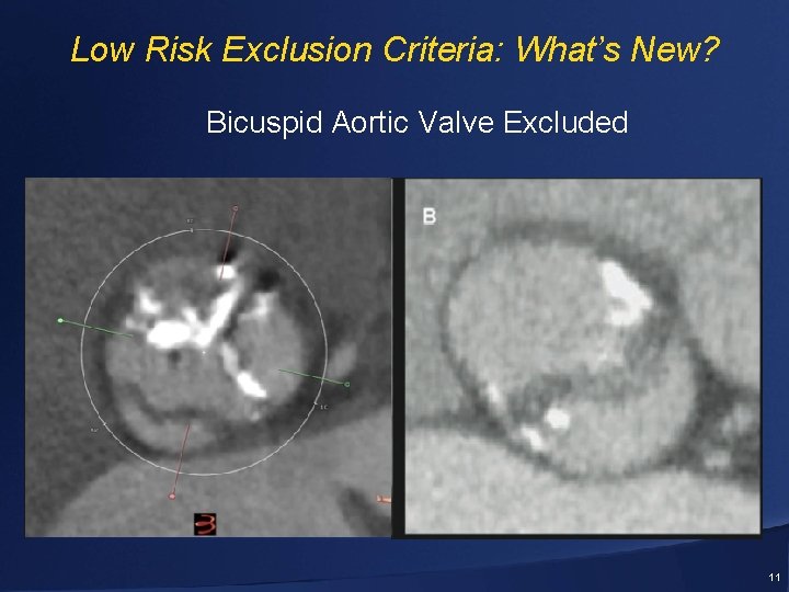 Low Risk Exclusion Criteria: What’s New? Bicuspid Aortic Valve Excluded 11 