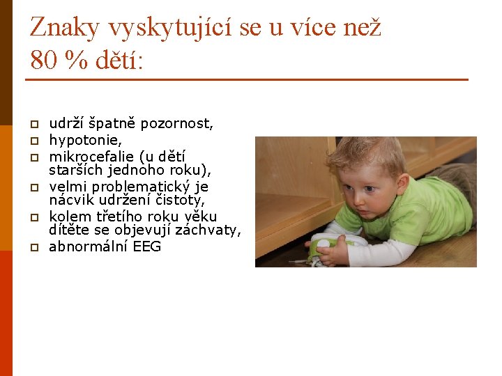 Znaky vyskytující se u více než 80 % dětí: p p p udrží špatně