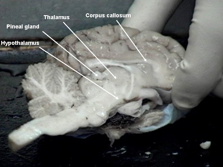 Thalamus Pineal gland Hypothalamus Corpus callosum 