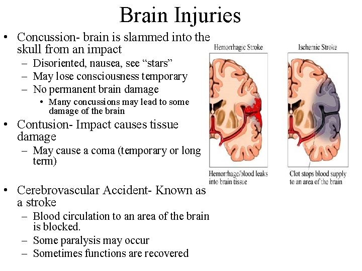 Brain Injuries • Concussion- brain is slammed into the skull from an impact –