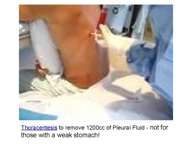 Thoracentesis to remove 1200 cc of Pleural Fluid - not for those with a