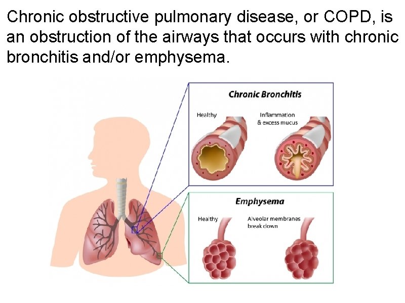 Chronic obstructive pulmonary disease, or COPD, is an obstruction of the airways that occurs