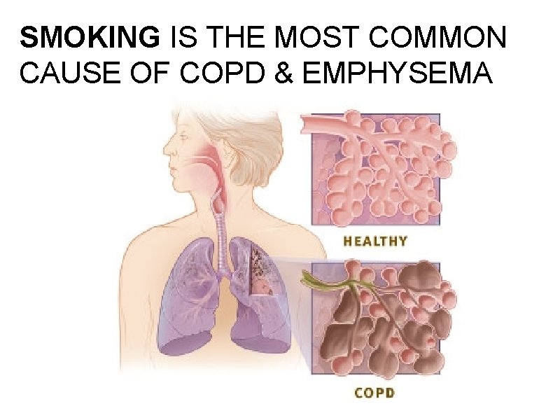 SMOKING IS THE MOST COMMON CAUSE OF COPD & EMPHYSEMA 