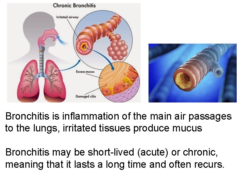 Bronchitis is inflammation of the main air passages to the lungs, irritated tissues produce