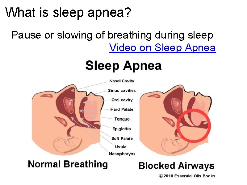 What is sleep apnea? Pause or slowing of breathing during sleep Video on Sleep