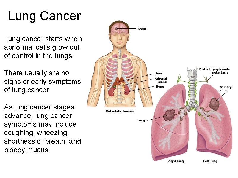 Lung Cancer Lung cancer starts when abnormal cells grow out of control in the
