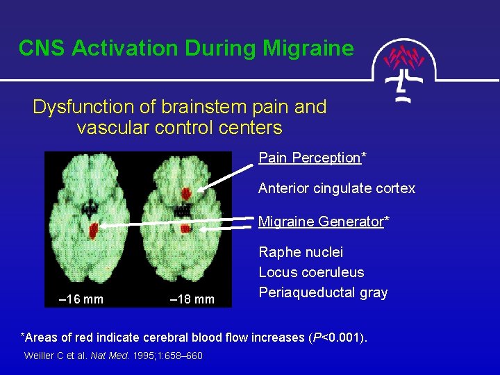 CNS Activation During Migraine Dysfunction of brainstem pain and vascular control centers Pain Perception*