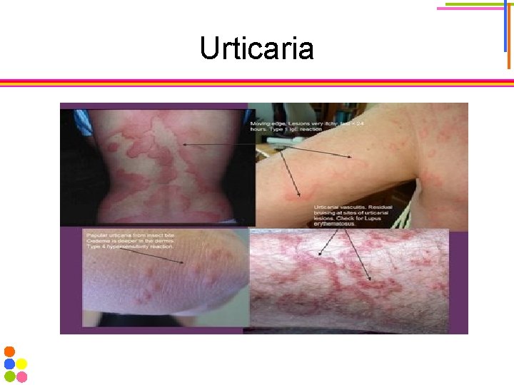 Urticaria 