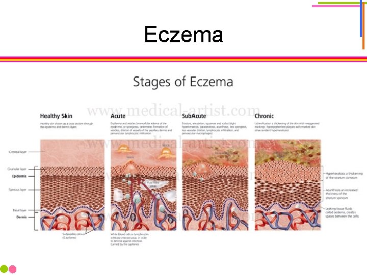 Eczema 