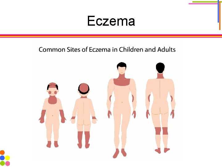 Eczema 