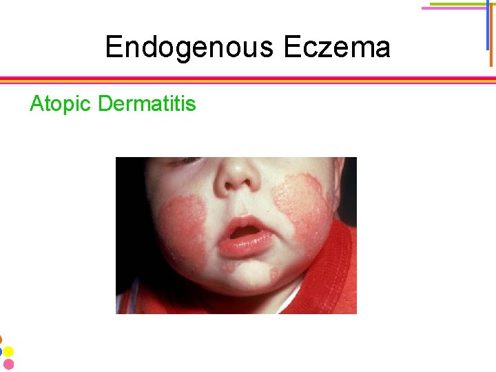 Endogenous Eczema Atopic Dermatitis 