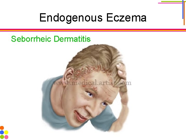 Endogenous Eczema Seborrheic Dermatitis 