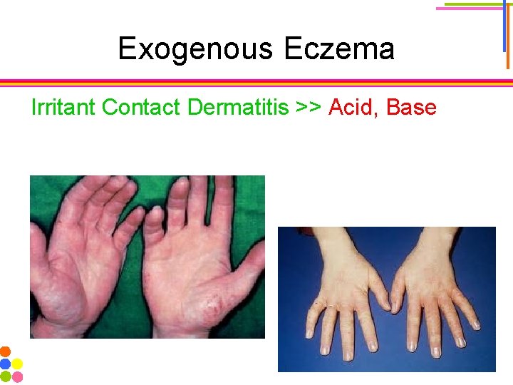 Exogenous Eczema Irritant Contact Dermatitis >> Acid, Base 