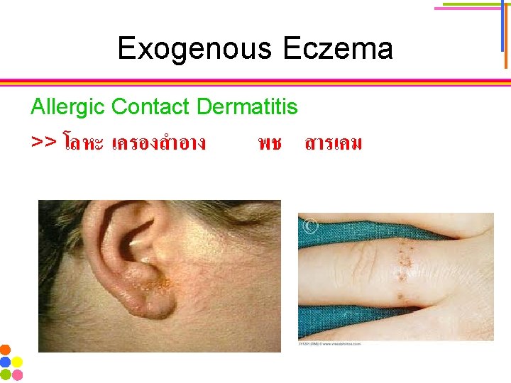 Exogenous Eczema Allergic Contact Dermatitis >> โลหะ เครองสำอาง พช สารเคม 