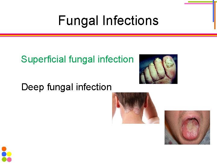 Fungal Infections Superficial fungal infection Deep fungal infection 