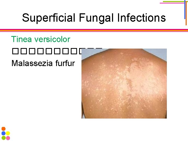 Superficial Fungal Infections Tinea versicolor ������ Malassezia furfur 