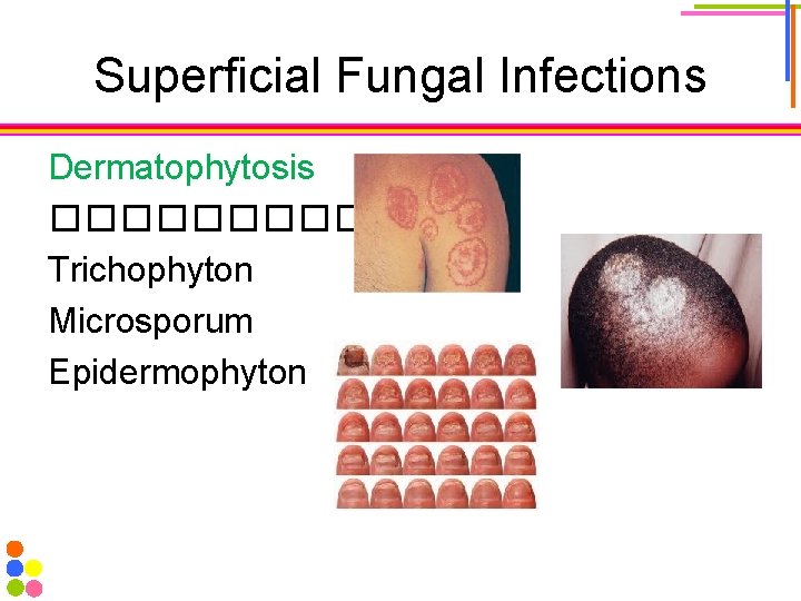 Superficial Fungal Infections Dermatophytosis ������ Trichophyton Microsporum Epidermophyton 