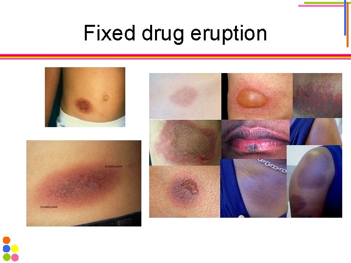 Fixed drug eruption 