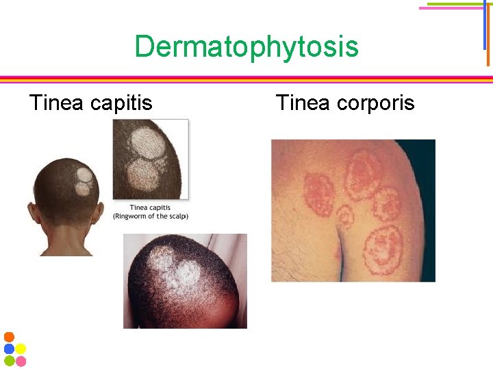 Dermatophytosis Tinea capitis Tinea corporis 