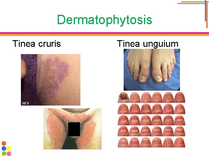 Dermatophytosis Tinea cruris Tinea unguium 