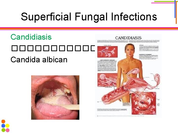 Superficial Fungal Infections Candidiasis ������ Candida albican 