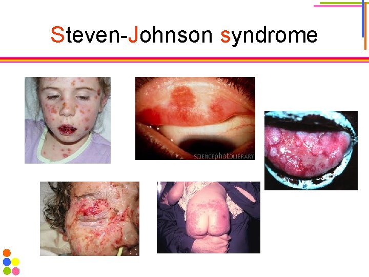 Steven-Johnson syndrome 