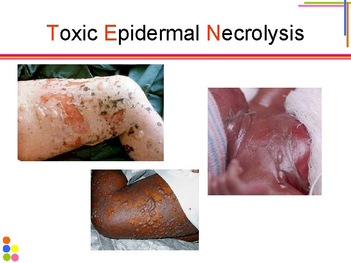 Toxic Epidermal Necrolysis 