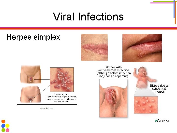 Viral Infections Herpes simplex 