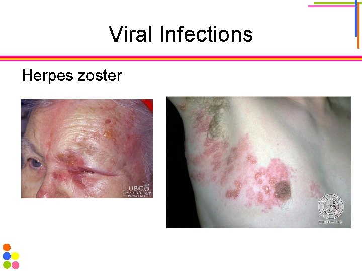 Viral Infections Herpes zoster 