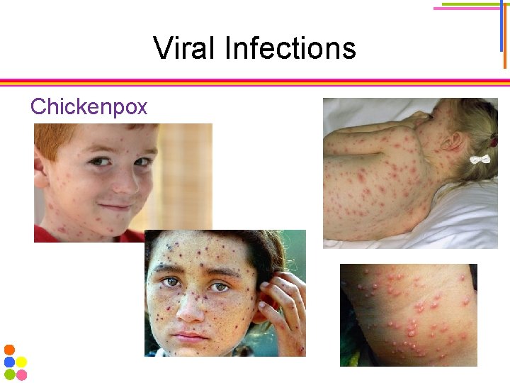 Viral Infections Chickenpox 