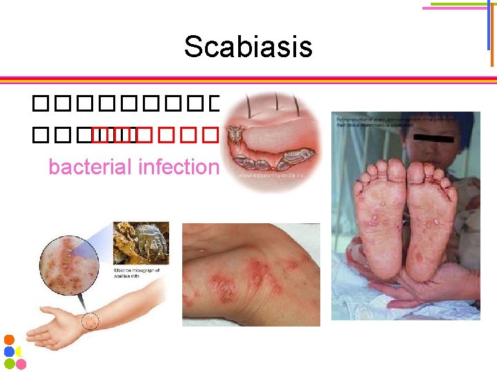 Scabiasis ������� bacterial infection 