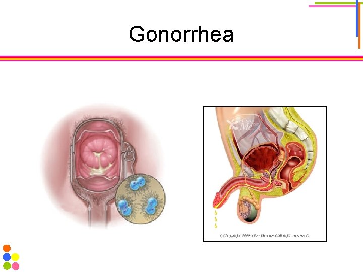 Gonorrhea 